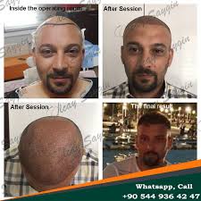 Pin On Best Doctor In Turkey For Hair Transplant Dr Olcay Saygin