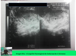 Presentacion De Caso Clinico Hematoma Retrocorial Steemit