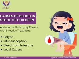 Image result for Blood in stool