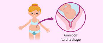 Amniotic fluid is a clear liquid that's mostly odorless. What Does Leaking Amniotic Fluid Feel Like Signs Causes