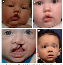 Figure 10 from Cleft Lip Repair, Nasoalveolar Molding, and Primary Cleft  Rhinoplasty.