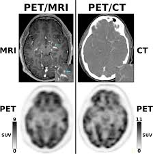 Does anybody have a good way to explain the difference? Pet Mri Versus Pet Ct In Oncology A Prospective Single Center Study Of 330 Examinations Focusing On Implications For Patient Management And Cost Considerations Springerlink