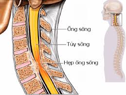 Hẹp ống sống