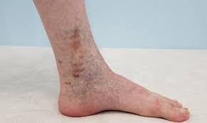 как избавиться от экземы на руках в домашних условиях Troficheskaya Venoznaya Ekzema Nizhnih Konechnostej Simptomy Diagnostika I Lechenie