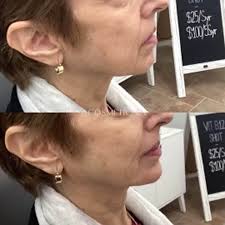 Patty Dalton — Botox, Filler, Fat Removal │ Aluma Medical Aesthetics