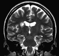 Gadolinium is definitely not safe during pregnancy. Gadolinium Deposition Practical Guidelines In The Face Of Uncertainty The Lancet Neurology