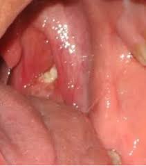 Pin On Tonsils