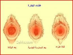 غشاء بكارة بالصور غشاء البكاره لدى البنات اجمل الصور