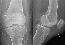 Image result for Prepatellar Bursa Injection