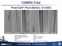 COBRA Trial COBRA Trial Cryoplasty or Conventional Balloon Post-dilation of  Nitinol Stents For Revascularization of Peripheral Arterial Segments  Subhash.