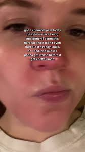 Chemical Peels for Dermititis