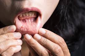 Image result for gum cancer symptoms
