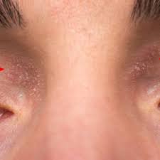 We did not find results for: Neurodermitis Bilder So Sieht Neurodermitis Aus Medumio