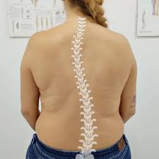Qué es la escoliosis? ¿Tiene tratamiento?