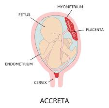 Image result for Retained Placenta