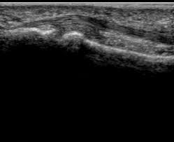 B, vascular supply of the ﬂexor digitorum profundus tendon insertion. Normal Hand Finger Ultrasound How To