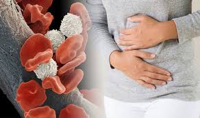 How is blood cancer diagnosed? Blood Cancer Symptoms Drenching Night Sweats Itchy Skin And Abdominal Problems Express Co Uk