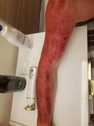 So, i decided to do some research online to learn about 刮痧 (gua sha), cào gió, and start this remedy. Resource01 Proxy Ulifestyle Com Hk Res V3 Image