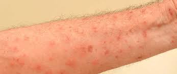 The patient presents with a generalised scaly rash. Scabies Blog