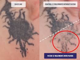 Perhaps the most common reason to get laser tattoo removal, however, is simply a change of heart. Describe Pfd Patch Rochester Tattoo Removal