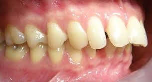 Causes Of Buck Teeth In Children Buck Teeth Teeth Growing Old