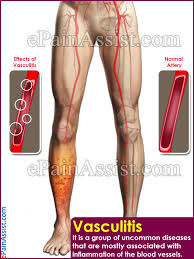 Maybe you would like to learn more about one of these? Vasculitis Symptoms Types Causes Treatment Complications Diagnosis