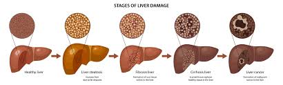 Cirrhosis is severe scarring of the liver caused by chronic liver disease. Organoids For The Development Of Drugs And Diagnostics For Nash