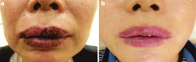 Scientists fear that toxins from tattoo ink could be absorbed into the body and accumulate in the spleen and kidneys, harming the body's ability to filter out impurities. A Baseline Findings In A 54 Year Old Lady Who Attended An Illegal Lip Download Scientific Diagram
