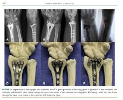 The flexor pollicis longus (fpl, latin flexor, bender; Proper Plate Position On Distal Radius Fractures Lowers Fpl Tendon Injury Risk Again Rob Gray Md