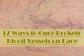 They're not dangerous to your health at all, but they are probably the best idea regarding how to get rid of broken blood vessels on face is make up and, more importantly, concealer. 17 Home Remedies To Cure Broken Blood Vessels On Face