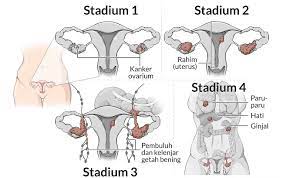 Pengobatan kanker serviks pengobatan kanker serviks tergantung stadium yang terdiagnosa. Kanker Ovarium Gejala Penyebab Dan Menangani Alodokter