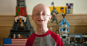 Omim #176670) is a very rare genetic disease, characterized by precocious ageing in early infancy. Fda Approves The First Drug For Progeria A Rapid Aging Disease Science News