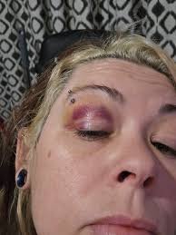 Do eyebrow piercings cause black eyes?