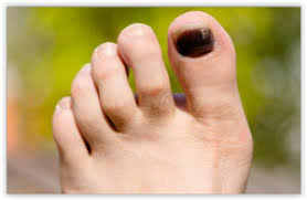 Si les soins que vous avez apportés à votre ongle incarné ne suffisent pas, votre médecin traitant vous prescrit un traitement local et des soins de podologie. Ongle Noir Choc Ou Maladie Bienfaits Danger Posologie Effets Secondaires