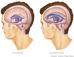 Image result for Hydrocephalus