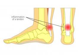 Trust your recovery to the experts! Achilles Tendonitis Symptoms And Treatment Caruso Foot And Ankle