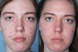 Pin On How To Use Tea Tree Oil For Acne