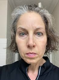 Before and after surgery recovery photos