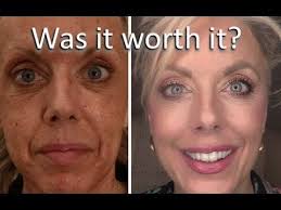 Über 80% neue produkte zum festpreis; Fractional Co2 Laser Review Youtube Profractional Laser Co2 Laser Resurfacing Fractional Laser Treatment