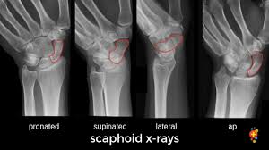 Image result for Scaphoid Fracture Signs