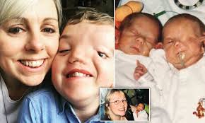 Stoke mother reveals son with Goldenhar syndrome's abuse
