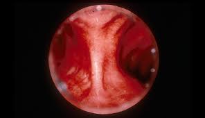 Image result for Acute Bronchitis