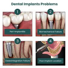 Image result for dental implant
