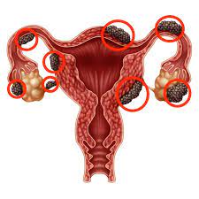 Learn more about the types, symptoms, causes, diagnosis, stages, treatment, and. Endometriosis Do I Have It Signs Symptoms And Pain Management