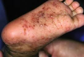 For a wearables company, being able to wear your tech is key. Skin Problems Contagious Rashes Bumps And Blisters