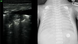 Treatment of breathing problems in premature babies. Different Ultrasound Appearance Of Grade Iv Respiratory Open I