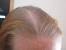 Pattern Hair Loss