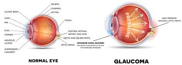 Glaucoma is usually treated with eye drops, although laser treatment and surgery can also be used. New Natural Glaucoma Treatment Acupuncture Golden Acupuncture