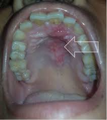 Image result for Mouth ulcers roof of mouth
