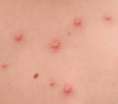 Image result for chickenpox